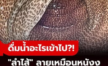 ไม่ใช่หนังงู แต่คือลำไส้มนุษย์ คนไข้เผยสิ่งที่ “ดื่มทุกวัน” หมอฟังจบรีบเตือน เสี่ยงโรคร้าย!