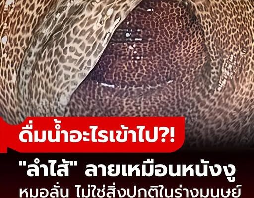 ไม่ใช่หนังงู แต่คือลำไส้มนุษย์ คนไข้เผยสิ่งที่ “ดื่มทุกวัน” หมอฟังจบรีบเตือน เสี่ยงโรคร้าย!